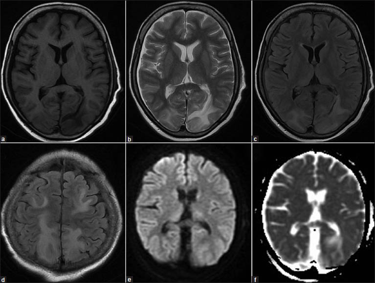 (a) T1-weighted magnetic resonance image showing hypointensities in bilateral parieto-occipital regions, left more than right, (b) T2-weighted and, (c) FLAIR images (FLAIR: Fluid-attenuated inversion recovery) showing hyperintensities in the same region, (d) FLAIR images showing bilateral frontal and parietal hyperintensities, (e) Diffusion weighted and, (f) Apparent diffusion coefficient images showing no restriction suggestive of vasogenic edema