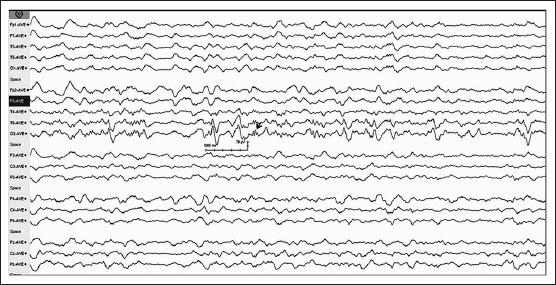 Initial electroencephalogram (EEG) of the patient on admission showed periodic short-interval (0.75 Hz) sharp waves [periodic lateralized epileptiform discharges (PLEDs)] of 100-150 μV amplitude over the right occipital region with medium-amplitude delta and slow theta activity, which was generalized. There were small-amplitude sharp wave discharges of ~ 50 μV amplitude (arrow) over the after-coming slow waves giving a PLEDs-plus morphology