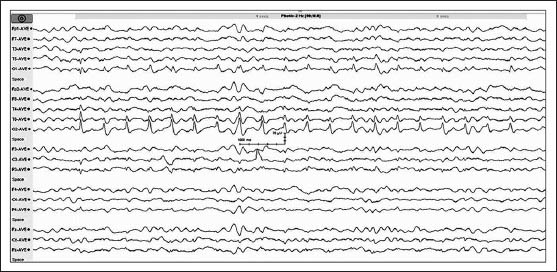 Second electroencephalogram (EEG) of the patient after giving valproate showed disappearance of periodic lateralized epileptiform discharges (PLEDs). Intermittent photic stimulation at low frequency showed grade III photoparoxysmal response (PPR) from bilateral occipital regions (right > left), although the background activity, which consisted of generalized medium-amplitude delta and slow theta activity