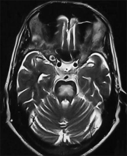 Hyperintense signal in T2-weighted images in the central pons suggestive of central pontine myelinolysis