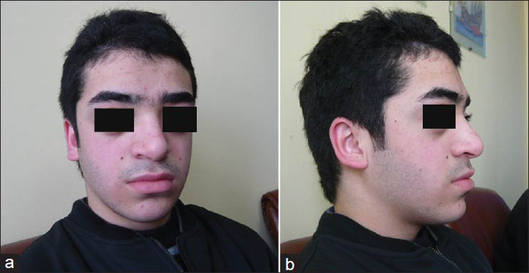 (a and b) Photographs show characteristic features of syndromic craniosynostoses in our patient: Hypertelorism, proptosis, midfacial hypoplasia, and abnormal head shape. (Published with permission and informed consent of the patient)