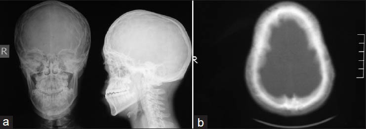 (a) Anteroposterior (AP) and lateral plain radiographs of head shows increase of AP diameter of the head and midfacial-orbital hypoplasia. Fusion of multiple calvarial sutures is also remerkable, (b) Axial cranial computed tomography scan demonstrated the abnormal head shape and the fusion of bilateral coronal and lambdoid sutures alongside with sagittal suture