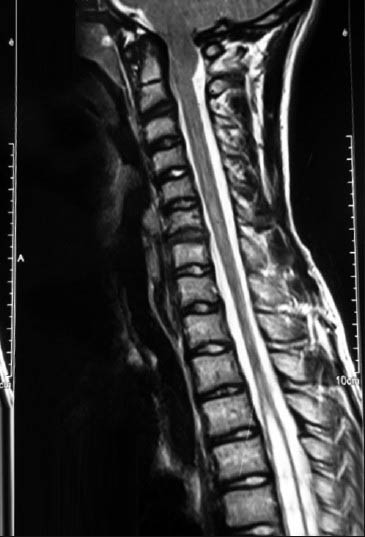 Sagittal T2-weighted magnetic resonance imaging shows a 18 mm cerebellar tonsil herniation into the foramen magnum with accompanying syringomyelia between Th 4 and Th 7 with the largest thickness of 11 mm