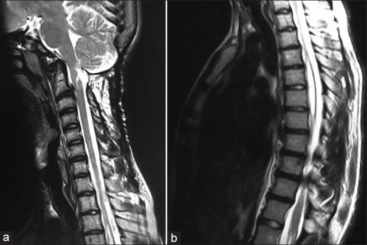 (a) Sagittal T2-weighted MRI of the craniocervical junction showed complete resolution of 18 mm cerebellar tonsil herniation, (b) Sagittal T2-weighted thoracal MRI showed relative resolution of the accompanying syringomyelia between Th 4 and Th 7 with the largest thickness of 7 mm