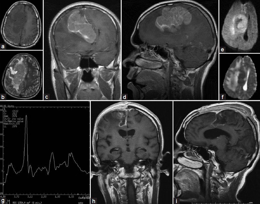 MRI of the brain revealing a right parasagittal lesion measuring 7.4 × 3.8 × 6.0 cm. It was hypointense on TIW images (a) Hyperintense on T2W images (b) With mass effect and midline shift. Figure 1c and d depict the contrast enhancement on T1W coronal and sagittal images. There was restriction on DWI (e) And hypointensity on ADC. (f) The MR spectroscopy revealed an elevated choline to creatinine ratio and loss of NAA on MRS (g) With surrounding peri-lesional edema with subfalcine/uncal herniation. H and i are post-operative TIW gadolinium images depicting complete excision of lesion