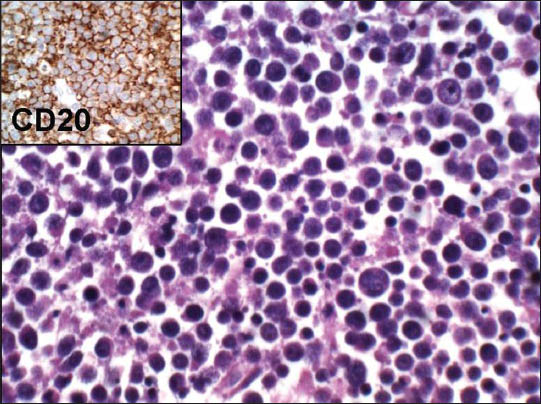 Paraffin section of non-Hodgkin lymphoma showing monomorphic round to oval cells with hyperchromatic nuclei, mitotic activity and (Inset) immunopositivity for CD20. (H and E ×400) [Inset: Avidin Biotin Complex Immunoperoxidase ×400]