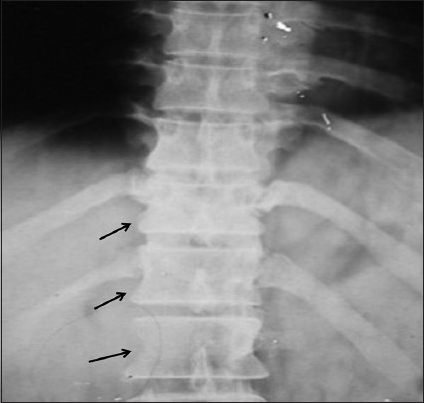 X-ray of dorsal spine showed (arrow marks) transverse process of L1 (Rt.) and pedicles of D12 and L1 nonvisualized (Destroyed)