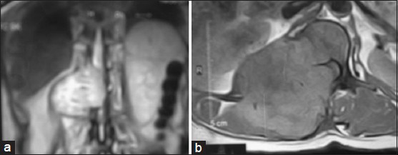 A magnetic resonance imaging scanT1W images A-coronal and B-axial section showed a huge mass involving the right para spinal area and spinal cannel at D11-L1, compressing the spinal cord (D11-D12) and destroyed the posterior arches of the vertebra (D12-L1)