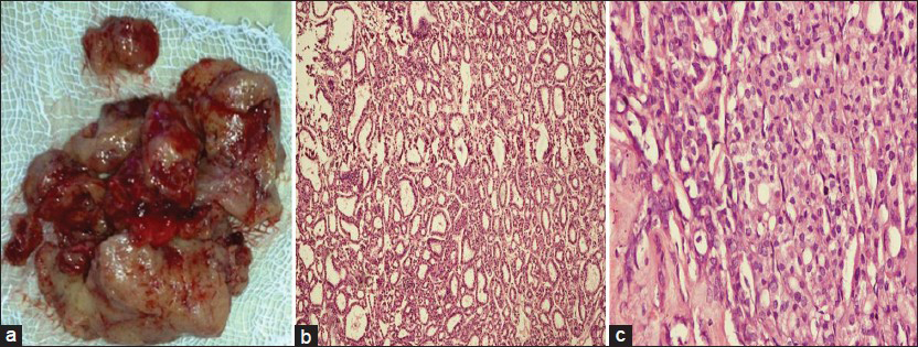 (a) Excised tumor. (b-c) Microphotograph of histopathological section showed follicular carcinoma of thyroid