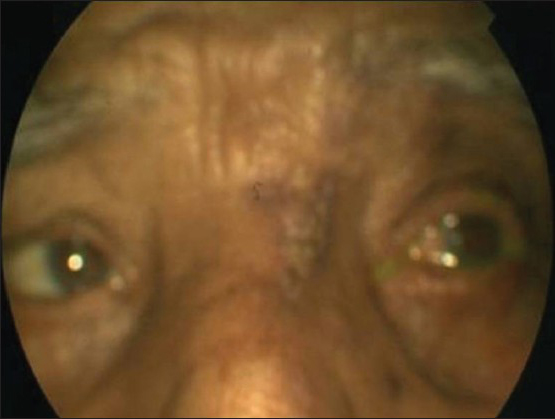 Cicatricial lesions on the left hemiface and limited abduction