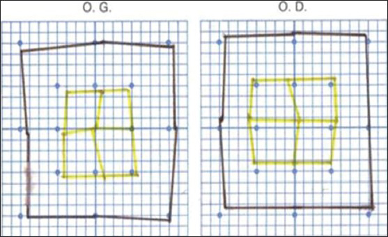 Improvement of the abducens nerve palsy on the Hess chart