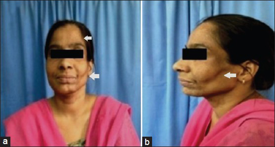 (a and b) Left hemifacial atrophy involving cheek, masseter, and temple (arrow)