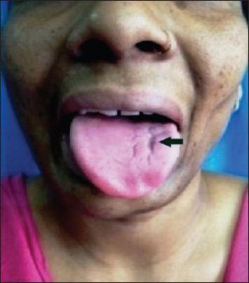 Atrophy of left half of tongue (arrow)