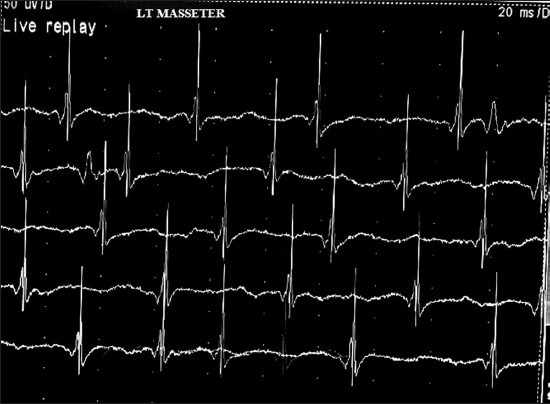 Needle electromyography of left masseter showing spontaneous high frequency complex repetitive discharges with normal motor unit action potentials even without spasm