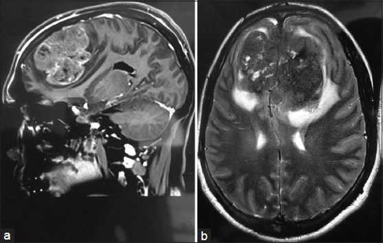 (a-b) Magnetic resonance imaging of the brain of an intracranial Rosai Dorfman disease patient showing a dural-based lesion seen in the frontal region involving the anterior half of the sagittal sinus with calcification