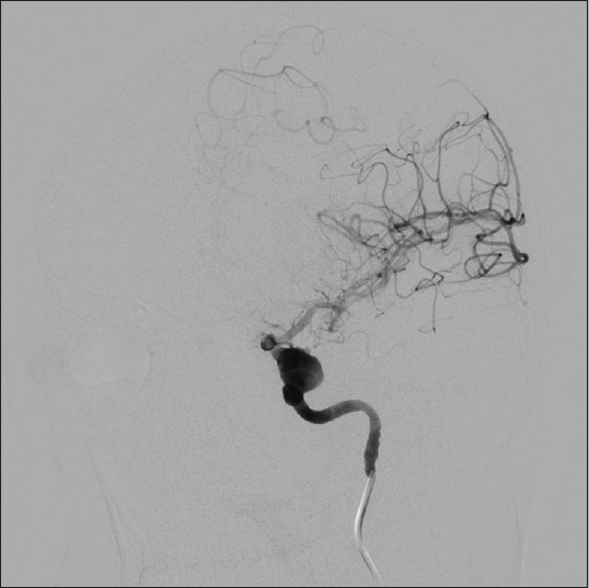 Cerebral angiography, oblique view, with right internal carotid injection showing a cavernous aneurysm