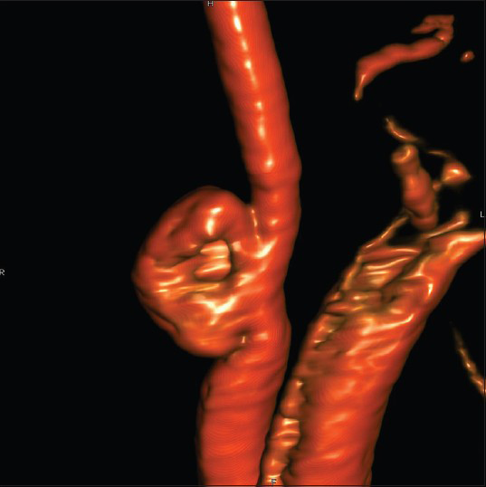 Vertebral angiogram with 3D rotational reconstruction image demonstrating a right vertebral artery aneurysm