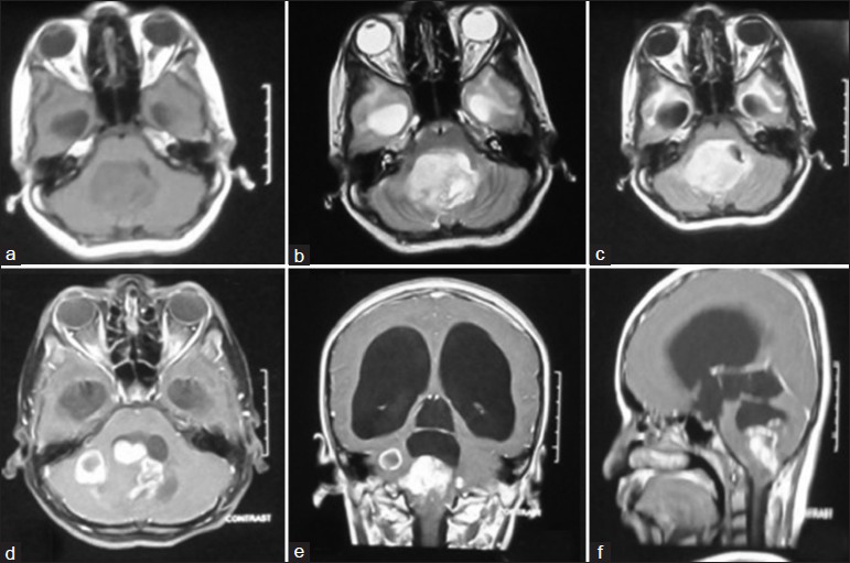 MRI brain (axial) sections T1W (a), T2W (b), and FLAIR (c) showed a well-defined heterogeneously hyperintense lesion in the midline fourth ventricle with solid-cystic components extending into brainstem and middle cerebellar peduncle. On gadolinium contrast T1W imaging (d-f), the lesion was enhancing heterogeneously. There was gross dilatation of the lateral and third ventricles with periventricular lucencies suggestive of raised ICP