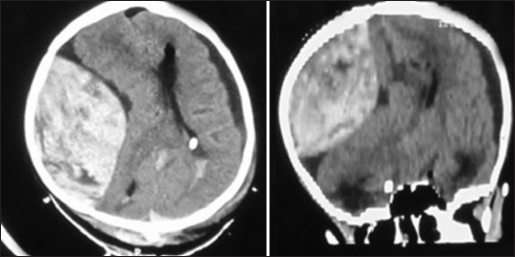 CT scan brain axial and sagittal (reformatted) images showing a large extradural hematoma in the right parietal region with compression of the ipsilateral lateral ventricle, midline shift of the brain parenchyma. Subdural hygroma is noted on the left side