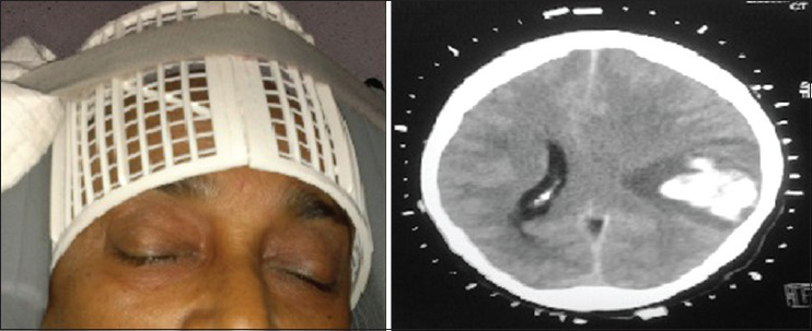 Craniomapper with axial marker computed tomography