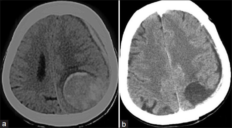 (a) Preoperative plain CT scan axial section showing a well-defined left parieto-occipital lesion with left fronto-parietal acute subdural hemorrhage and midline shift. (b) Postoperative plain CT scan axial section showing total excision of the tumor and evacuation of the SDH