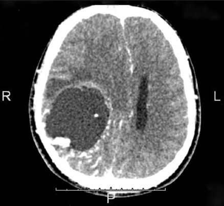 The CT image showing the presence of the intra-axial space occupying lesion in the right hemisphere