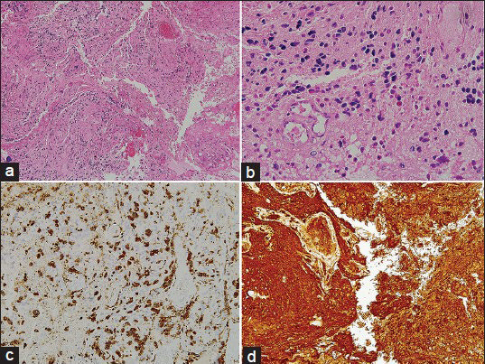 The CT image shown above notes the presence of the intra-axial space occupying lesion in the right hemisphere. Above Right (a): H and E, ×100,Above Left (b): H and E, ×400, Below Right (c): CD 68 staining depicting positivity for macrophages, Below Left (d): GFAP staining depicting positivity