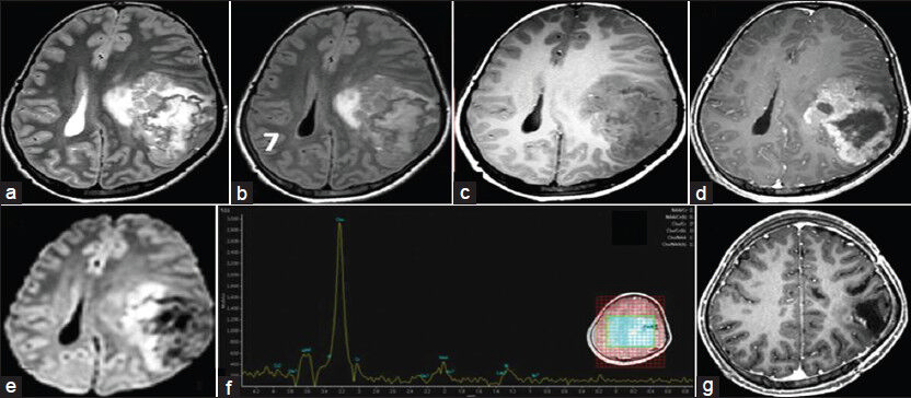 (a and b) The axial T2W/FLAIR image shows a large extra-axial mass lesion with heterogenous signal intensity and edema of the adjacent brain parenchyma; (c and d) The axial T1W image shows a hypointense lesion, which shows strong heterogeneous enhancement; (e) DWI shows areas of restricted diffusion; (f) MRS shows elevated choline; (g) Postoperative T1W images reveal no residual mass lesions