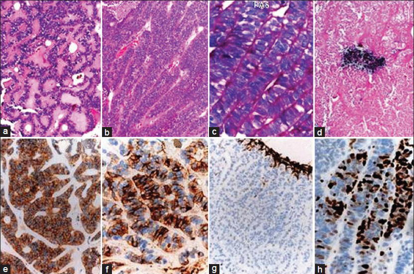 The tumor shows immature neuroepithelial cells in papillary (a) and trabecular arrangement (b), with a PAS positive external limiting membrane (c), and necrosis and calcification (d). The tumor cells show strong synaptophysin (e) and focal EMA positivity (f), while GFAP is negative (g). MIB-1 labeling is high (h). [a and b: H and E, ×Obj.10, c: PAS ×Obj.20, d: H and E, ×Obj.20, e: Synaptophysin ×Obj.20, f: EMA ×Obj.40, g: GFAP ×Obj.10, h: MIB-1 ×40]