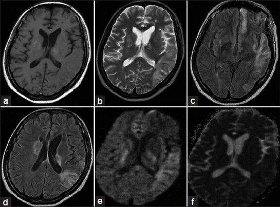 Magnetic resonance imaging of the brain T1 (a), T2 (b), Fluid attenuated inversion recovery (c and d), diffusion weighted image (e) and apparent diffusion weighted image (f) Sequences showing bilateral infarcts with hemorrhagic transformation