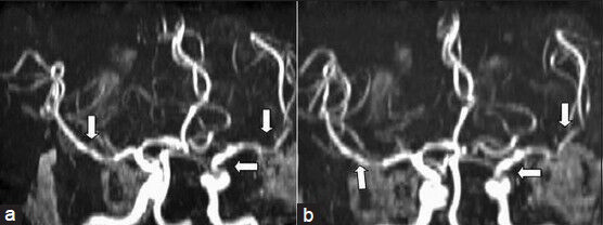 Magnetic resonance angiography of the brain (a and b) showing irregularity and dilation of intracranial vessels (arrows)