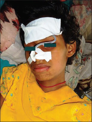 Victim of organophosphorus poisoning showing mask-like facies