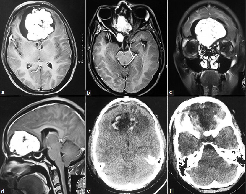 (a and b) Axial contrast MRI showing enhancing lesion with cystic areas in basifrontal region and olfactory groove. (c) Coronal and (d) Mid Sagittal MRI showing lesion in the basifrontal region. (e and f) Post operative CT scan showing gross total excision of the lesion