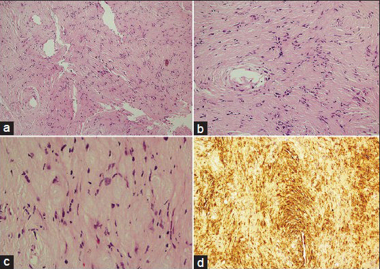 (a) (H and E, ×40) magnification showing Hypercellular (Antoni-A) and Hypocellular (Antoni-B) areas with hyalinised blood vessels. (b) 100× magnification showing tumor cells which are ovoid to spindle shaped. (c) 200× magnification showing nuclear characteristics which are elongated, wavy with pointed ends. (d) S-100 protein immunostaining showing diffuse nuclear and cytoplasmic immunoreactivity