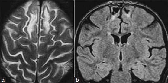 (a) Axial T2W and (b) Coronal FLAIR images show bilateral frontal lobe porencephalic cysts