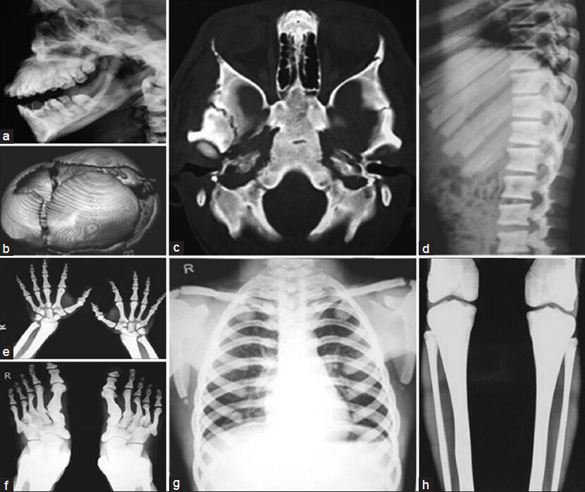 (a) X-ray showing obtuse gonial angle and crowded teeth (b) CT head showing open sutures and fontanelle with multiple Wormian bones (c) Axial CT head, showing sclerosed skull base (d) Dorsolumbar spine X-ray showing sclerosed, spool shaped vertebrae (e) X-ray both hands and (f) Feet showing acro-osteolysis (g) Narrow chest; the clavicles do not appear hypoplastic in this case (h) X-ray both legs, showing sclerosed long bones; there is no ‘bone within bone appearance’ or ‘Erlenmeyer flask deformity’ thus differentiating from osteopetrosis. Also see the supplementary file