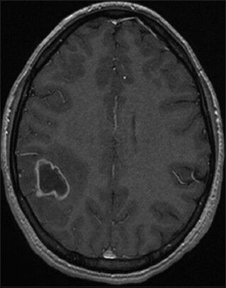 Axial T1-weighted magnetic resonance imaging with gadolinium showing a right parietal rim-enhancing lesion