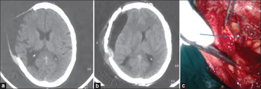 (a) CT scan of brain showing the post-decompressive status with hypodense collection beneath the meningo-galeal complex with no evidence of mass effect. (b) Post-bone flap replacement CT scan showing mild extradural hyperdense collection, with hypodense subdural collection with midline shift and mass effect. (c) Intraoperative picture showing thickened dural membrane (arrow)