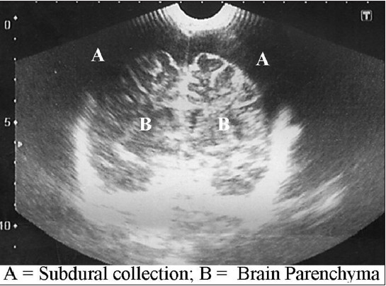 Transfontanellesonography of a child with bilateral subdural collection (annotated)