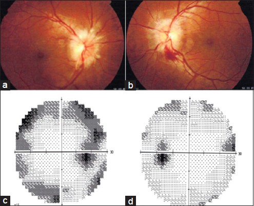 (a) Right fundus showing papilledema, (b) left fundus showing papilledema with splinter hemorrhage, (c) right eye showing enlargement of blind spot with superior and inferior areas of depression, (d) left eye enlargement of blind spot