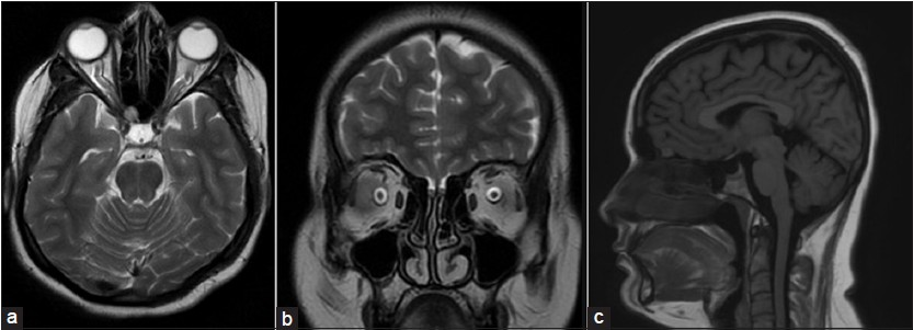 (a) T2-axial brain showing tortuosity of bilateral optic nerves along with prominent optic nerve sheath, (b) T2-coronal brain showing enlarged subarachnoid space around the optic nerve, (c) T1 sagittal showing empty sella