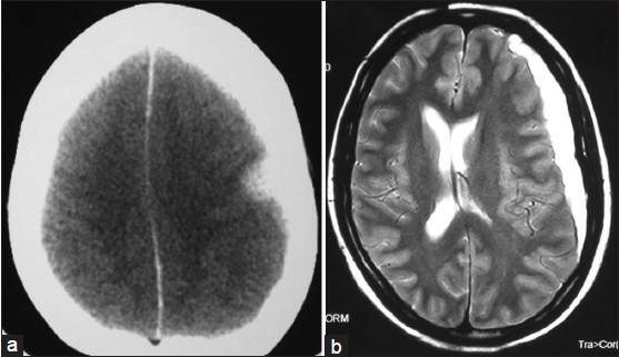 (a) CT scan and (b) MRI T2-weighted images showing left FTP acute SDH with mass effect