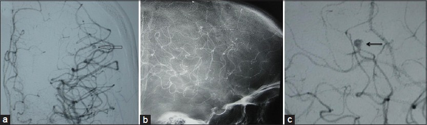 Digital subtraction angiography (DSA): (a) AP and (b, c) Lateral views showing aneurysm (arrow) at M5 segment