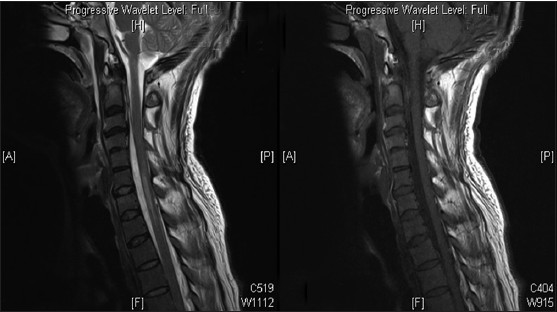 Non-contrast computed tomography cervical spine showing C4-C5 block vertebrae without any fracture or dislocation