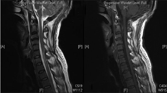 Sagittal section magnetic resonance imaging showing collection anterior to the cord compressing the cord and cord contusion at C6-C7