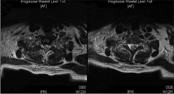 Axial section magnetic resonance imaging showing hyperintense collection on T2 anterior to the cord and causing cord compression