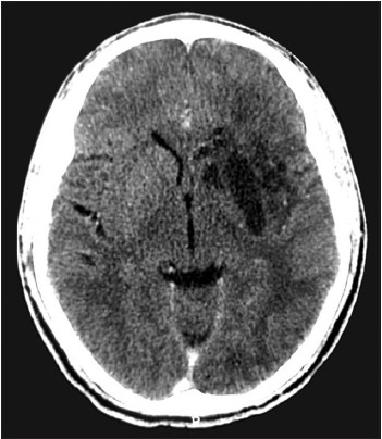 Contrast-enhanced CT, showing non-enhancing hypodense lesion in the left corpus striatum and insula cortex consistent with infarcts