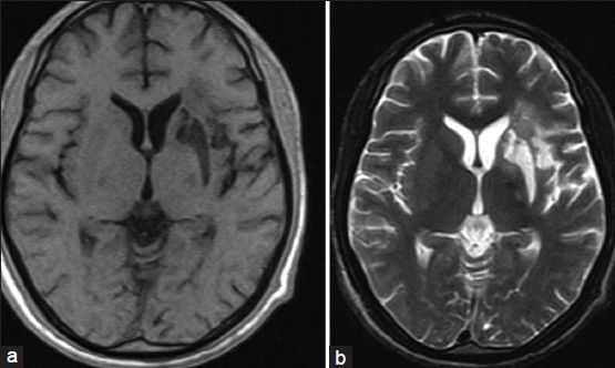 (a) T1W axial MRI image showing hypoiintense lesion in the left corpus striatum and insula cortex (b) T2W axial MRI image showing hyperintense lesion in the left corpus striatum and insula cortex