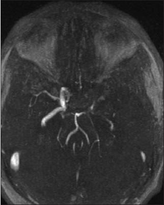 MRA showing marked reduction in the caliber of the left internal carotid artery, with occlusion of the left middle and anterior cerebral artery