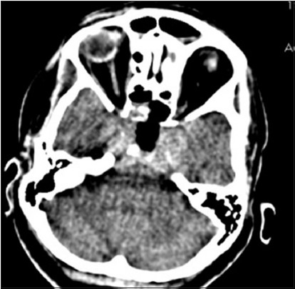 Case 1: CT scan brain plain done on 1st post op day showing partial decompression of the tumor with a residual tumor in sella supra-sellar region and bilateral cavernous sinuses